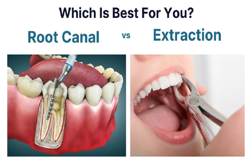 Root Canal Therapy in Houston